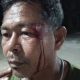 Pelipis Pecah Hingga Berdarah, Korban Pertanyakan Keseriusan Polsek Gane Timur Tangani Laporan
